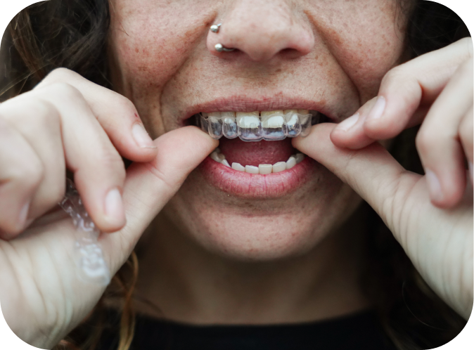 Prendre soin de son appareil orthodontique Orthodontiste Marseille 10 | Drs Couchat, Gaillard & Toga