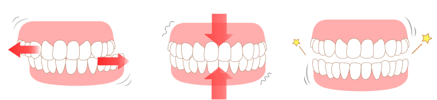 Bruxisme Orthodontiste Marseille 10 | Drs Couchat, Gaillard & Toga