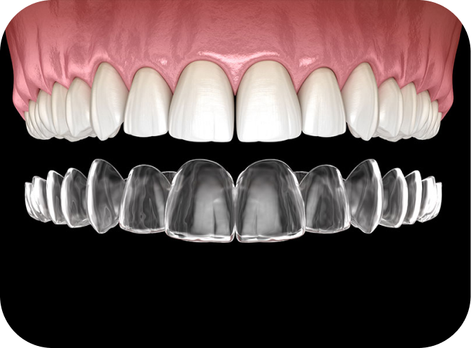 Contention : à quoi sert-elle? Orthodontiste Marseille 10 | Drs Couchat, Gaillard & Toga