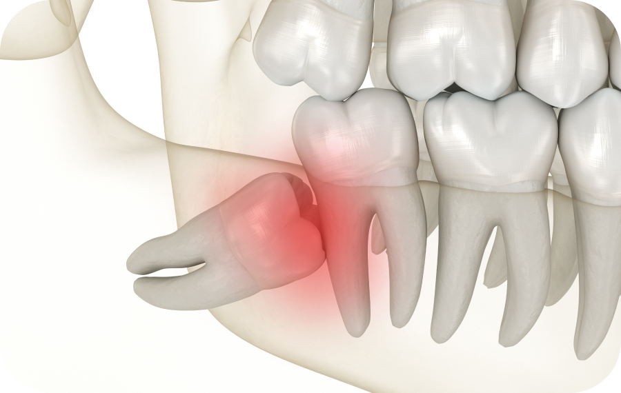 Dents incluses Orthodontiste Marseille 10 | Drs Couchat, Gaillard & Toga