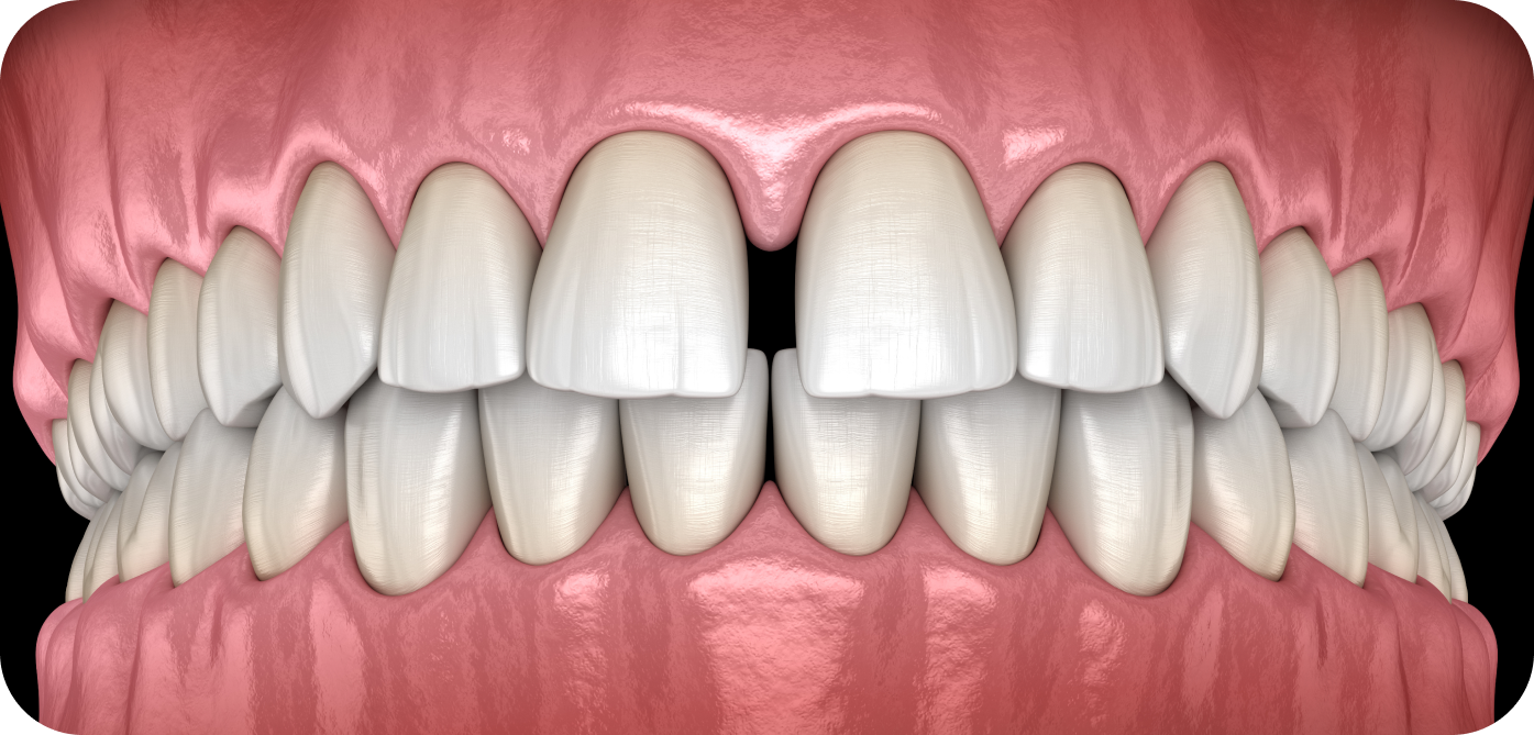Diastème Orthodontiste Marseille 10 | Drs Couchat, Gaillard & Toga