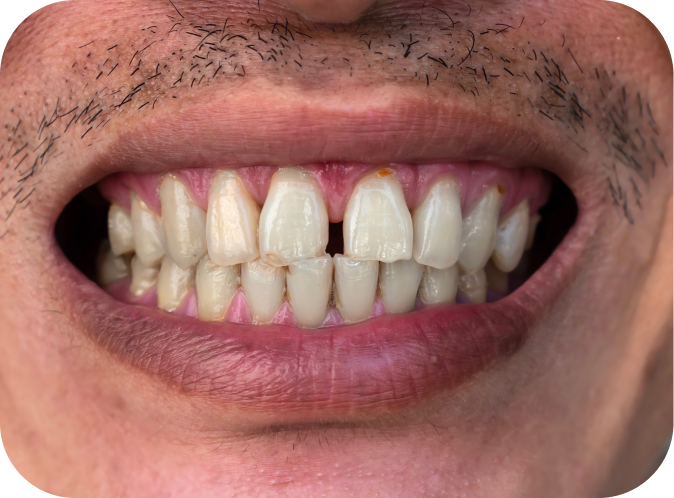 Diastème Orthodontiste Marseille 10 | Drs Couchat, Gaillard & Toga