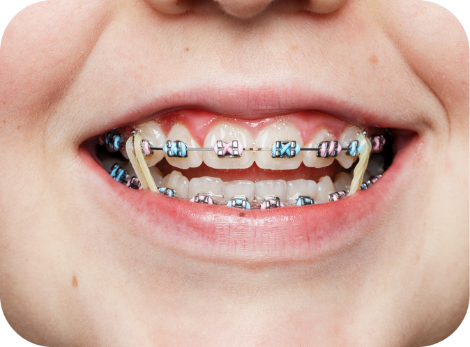 Élastiques orthodontiques Orthodontiste Marseille 10 | Drs Couchat, Gaillard & Toga