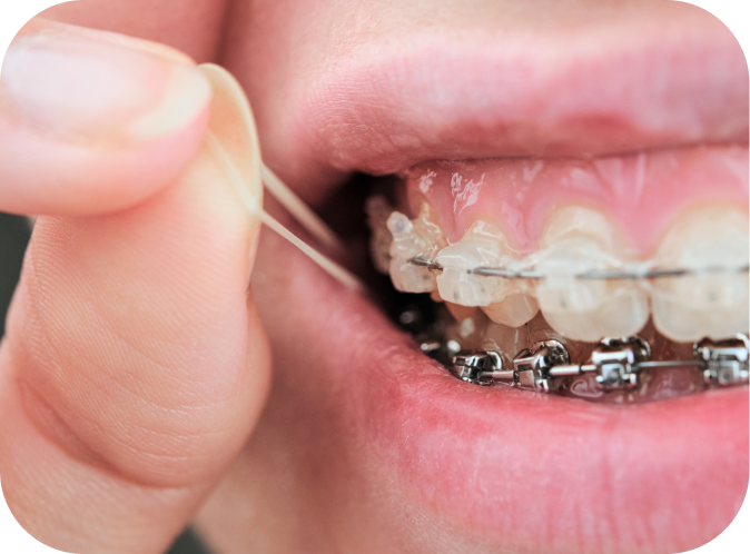 Élastiques orthodontiques Orthodontiste Marseille 10 | Drs Couchat, Gaillard & Toga