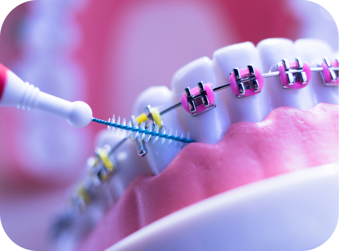 Élastiques orthodontiques Orthodontiste Marseille 10 | Drs Couchat, Gaillard & Toga