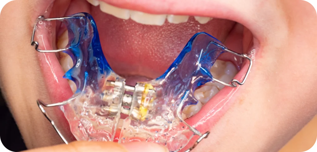 Encombrement  Orthodontiste Marseille 10 | Drs Couchat, Gaillard & Toga