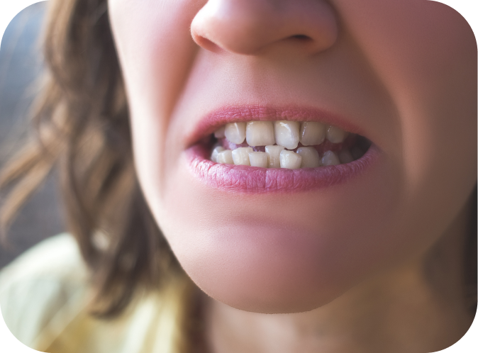 Encombrement  Orthodontiste Marseille 10 | Drs Couchat, Gaillard & Toga