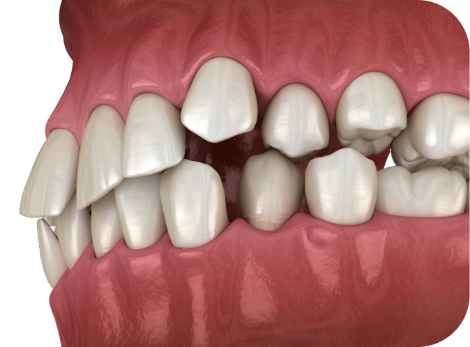 Encombrement  Orthodontiste Marseille 10 | Drs Couchat, Gaillard & Toga