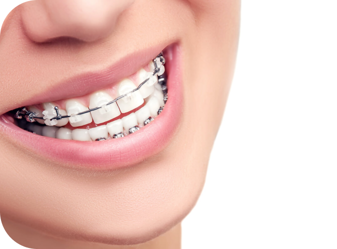 Appareils multi-attaches Orthodontiste Marseille 10 | Drs Couchat, Gaillard & Toga