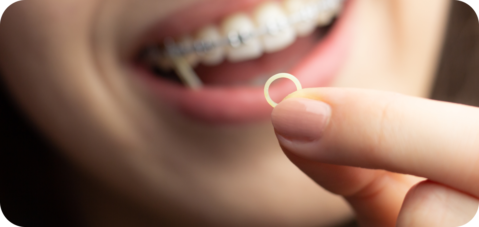 Élastiques orthodontiques Orthodontiste Marseille 10 | Drs Couchat, Gaillard & Toga