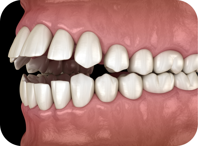 Problème de déglutition  Orthodontiste Marseille 10 | Drs Couchat, Gaillard & Toga