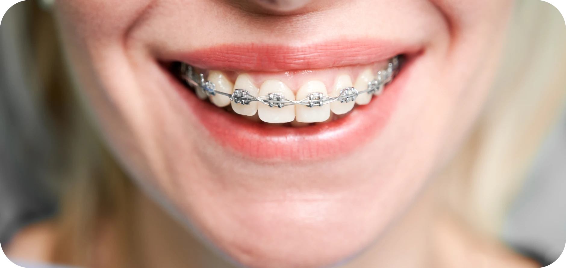 Problèmes parodontaux en contexte orthodontique Orthodontiste Marseille 10 | Drs Couchat, Gaillard & Toga
