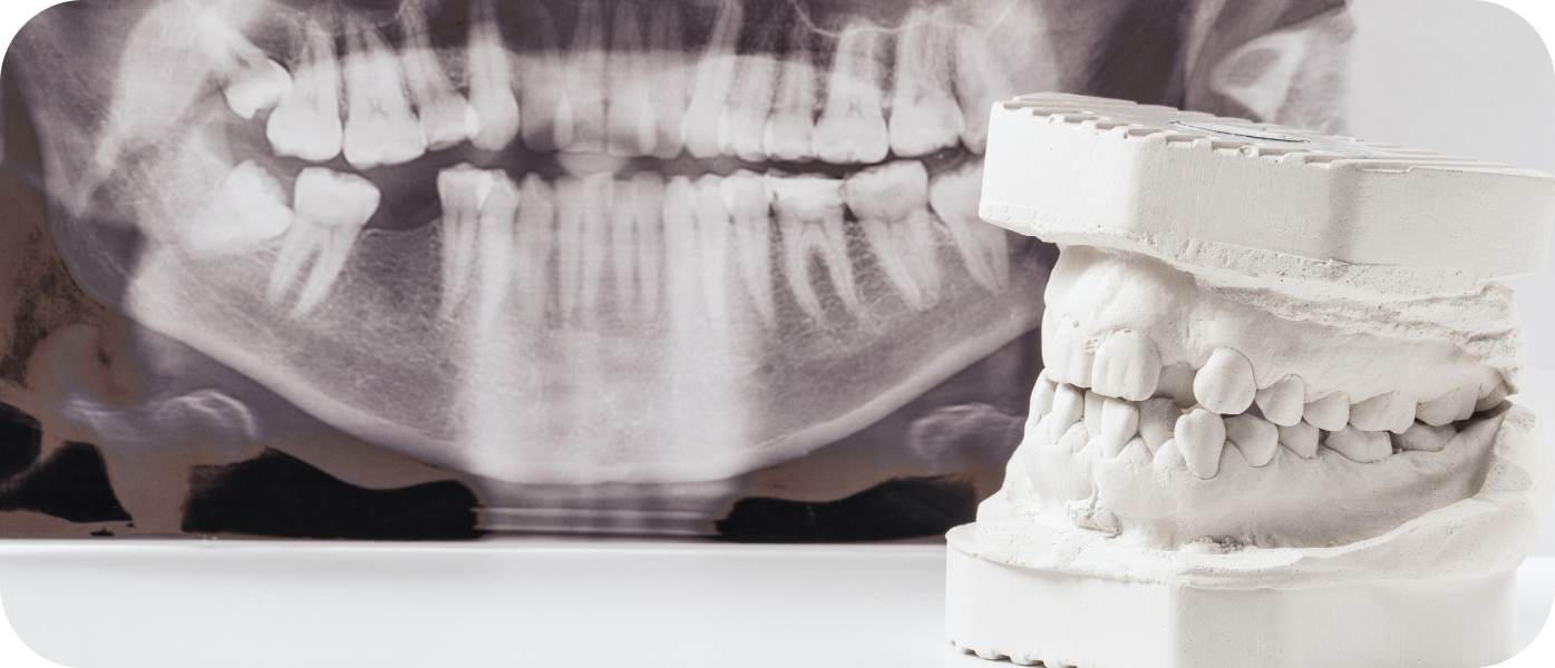 Dents incluses Orthodontiste Marseille 10 | Drs Couchat, Gaillard & Toga