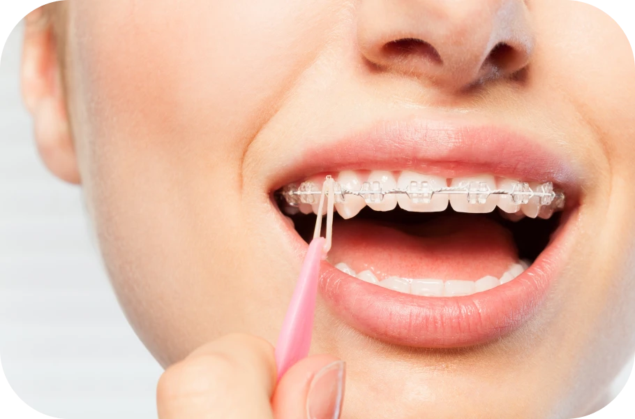 Élastiques orthodontiques