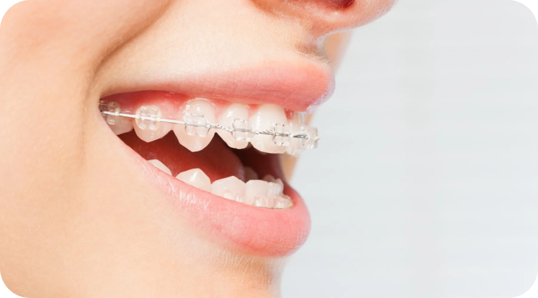 Appareils multi-attaches