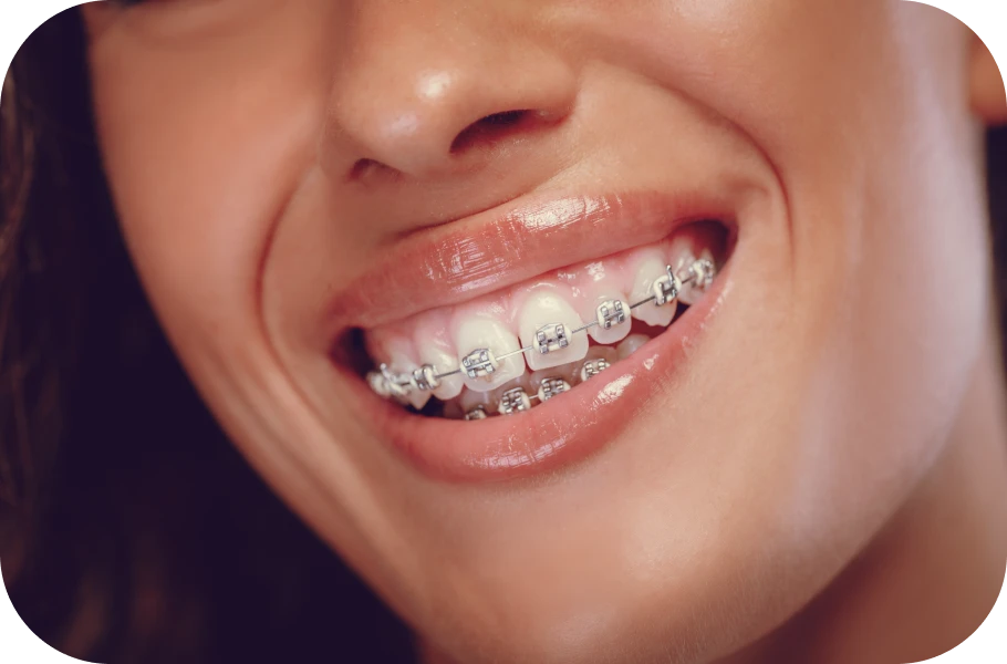 Problèmes parodontaux en contexte orthodontique
